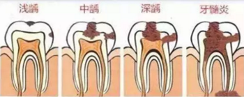 当心“腹黑”龋齿，牙齿有个小洞也要补！